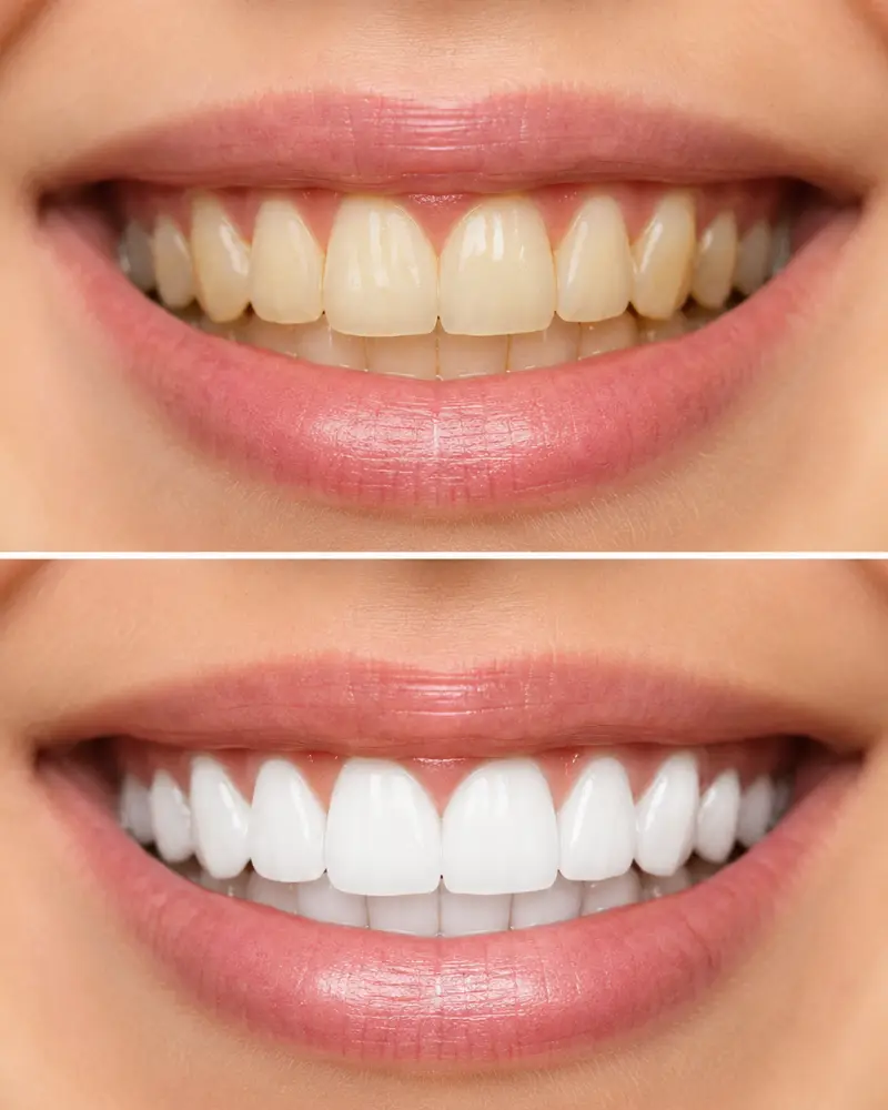 Comparaison avant et après un blanchiment dentaire : dents jaunies en haut, éclaircies en bas
